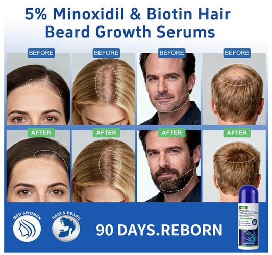 Tratamiento Capilar con Minoxidil y Biotina para Mujeres y Hombres
